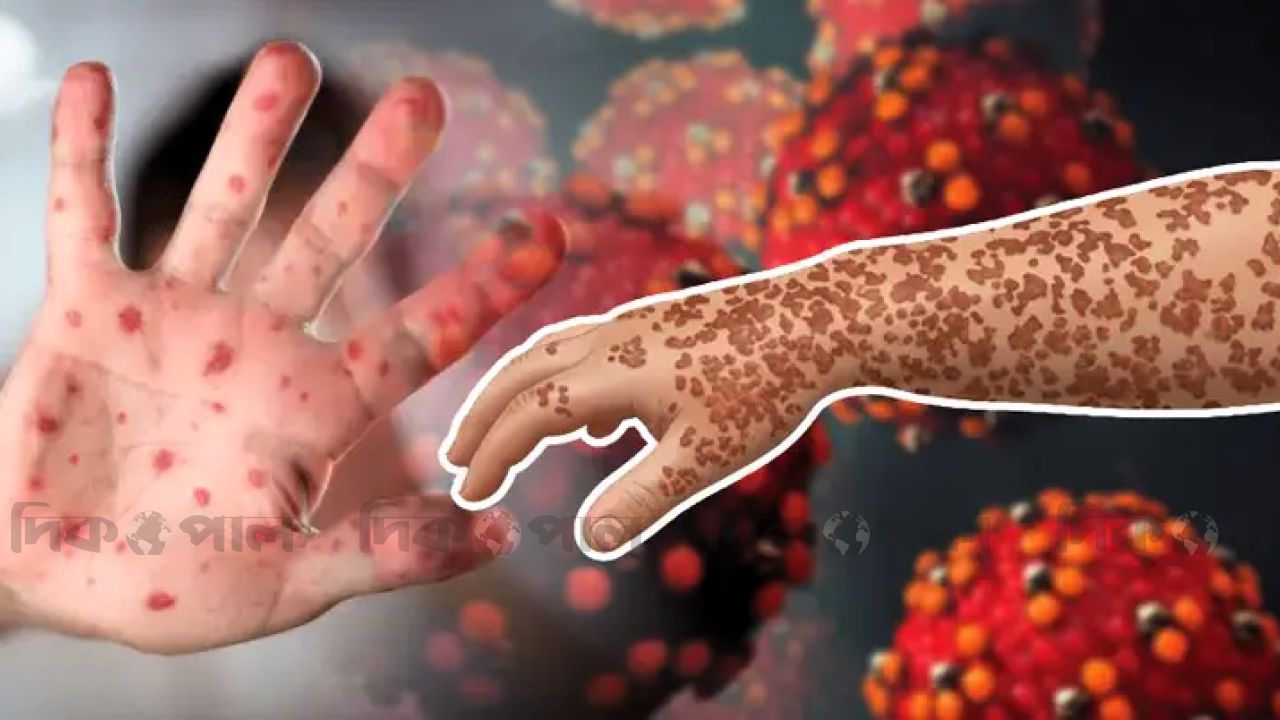 হামের পুরোনো বি৩ ধরনেই বাড়ছে সংক্রমণ